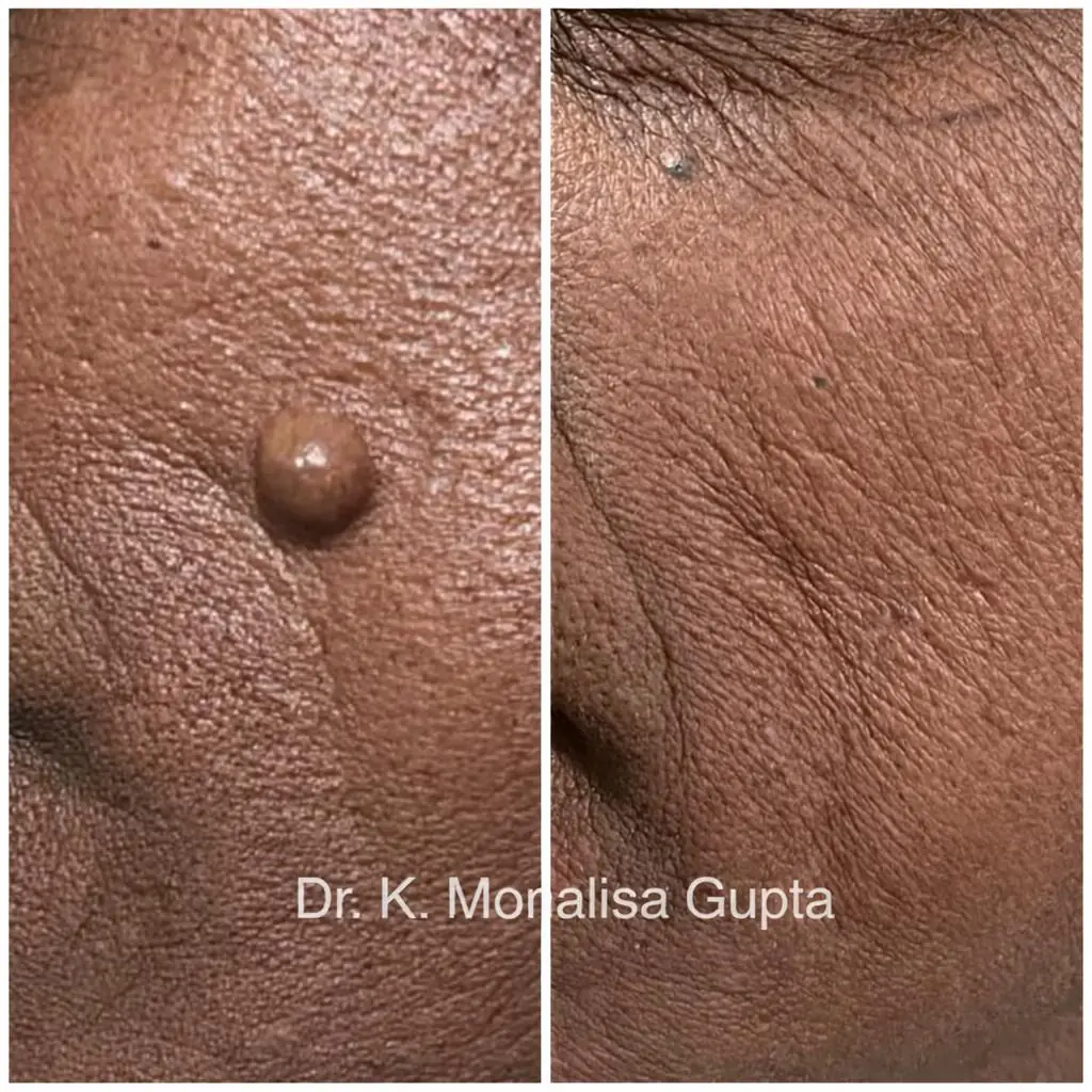 Mole removal on the cheek before and after, Dr. K. Monalisa Gupta, Motihari