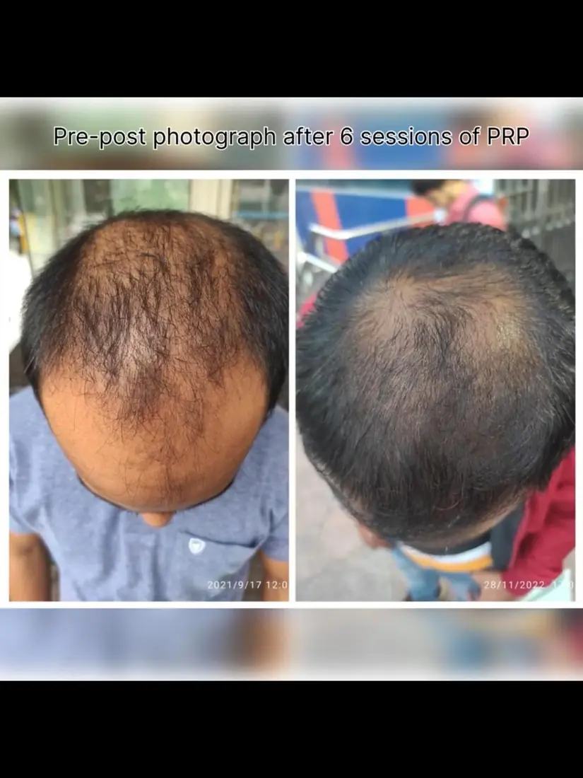 PRP for hair before and after six sessions, Dr. K. Monalisa Gupta, Motihari