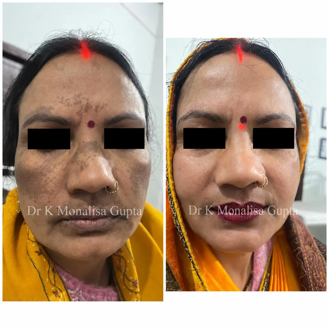 Melasma and facial pigmentation before and after treatment, Motihari