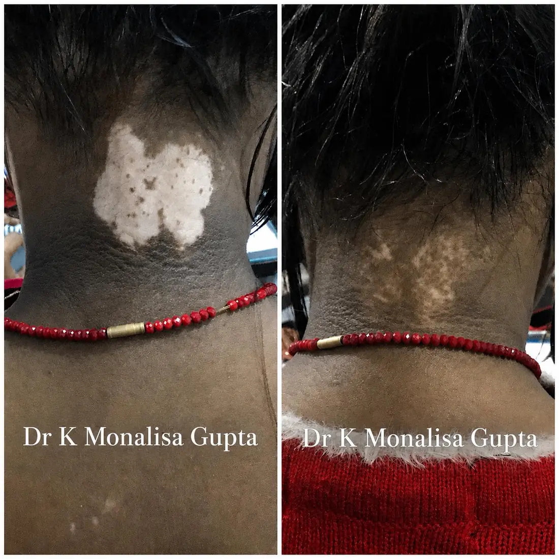Vitiligo patch on the neck repigmenting after treatment, Motihari