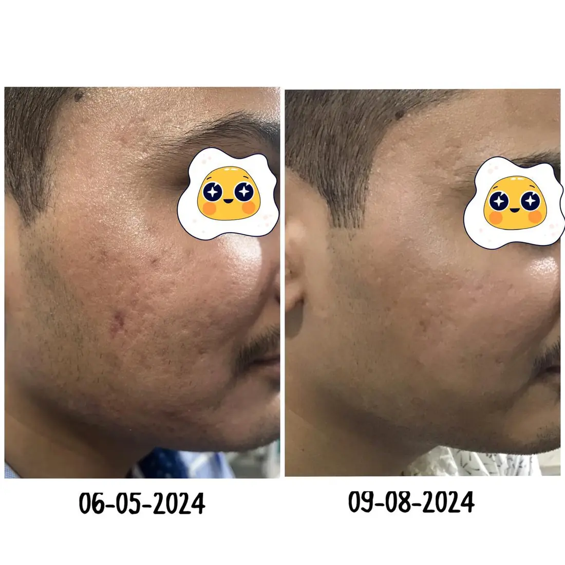 Acne scar treatment before and after on the cheek, Dr. K. Monalisa Gupta, Motihari