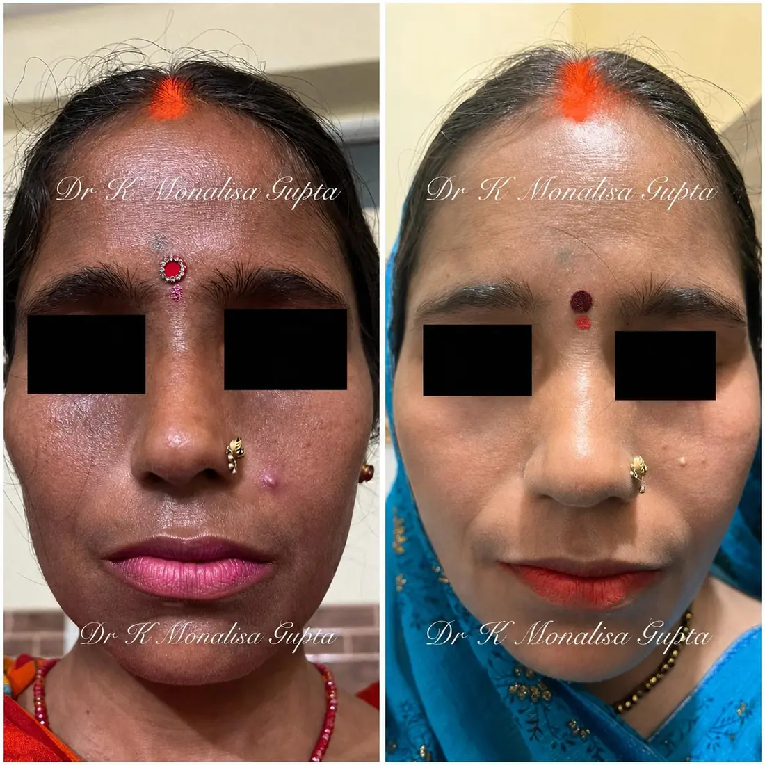 Facial pigmentation and skin texture before and after rejuvenation, Motihari