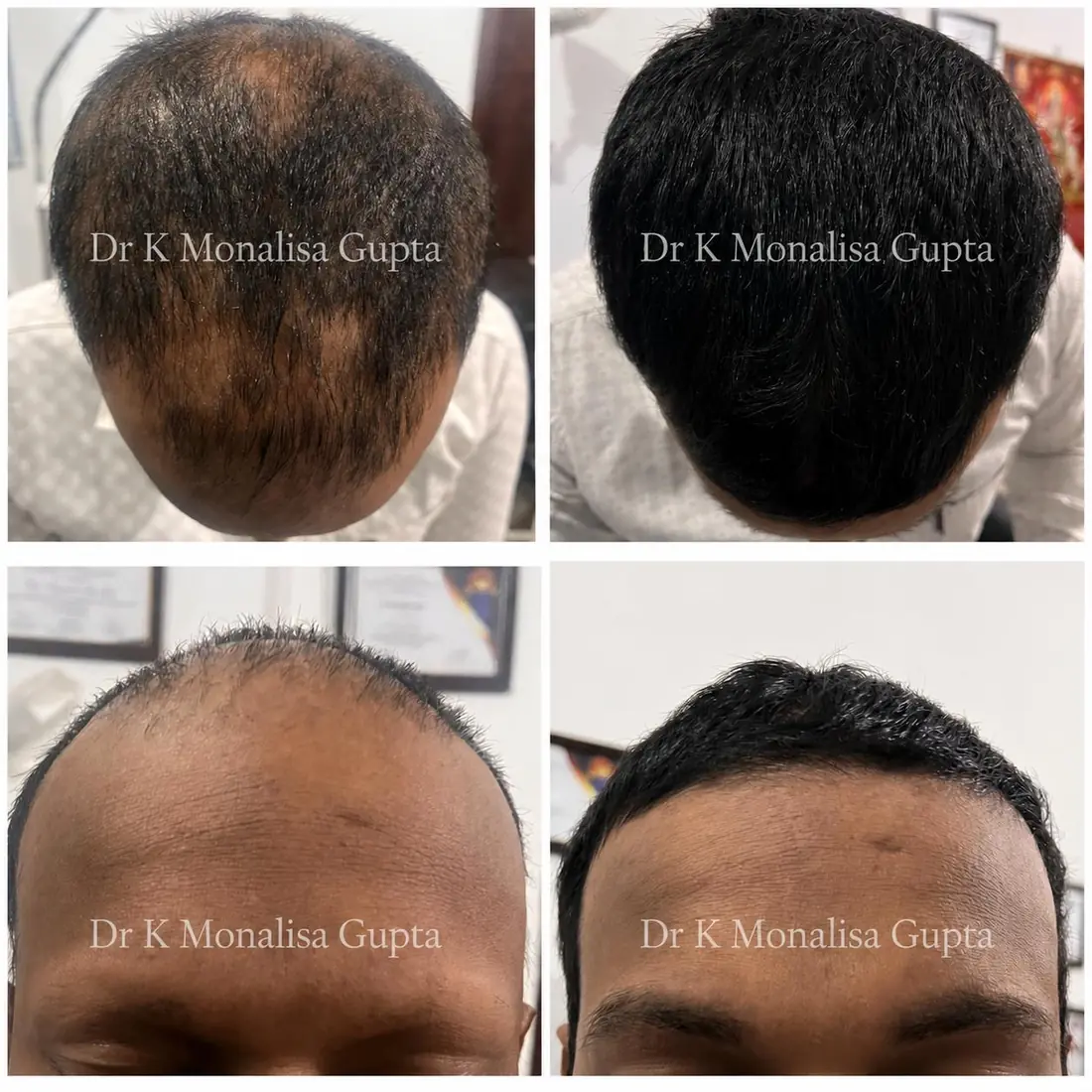 Hair regrowth before and after treatment for male pattern hair loss, Motihari