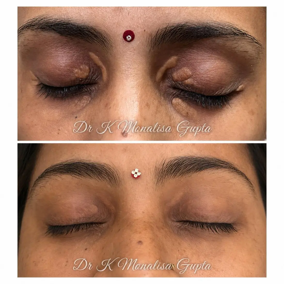 Eyelid growth removal before and after, clear upper eyelids, Motihari