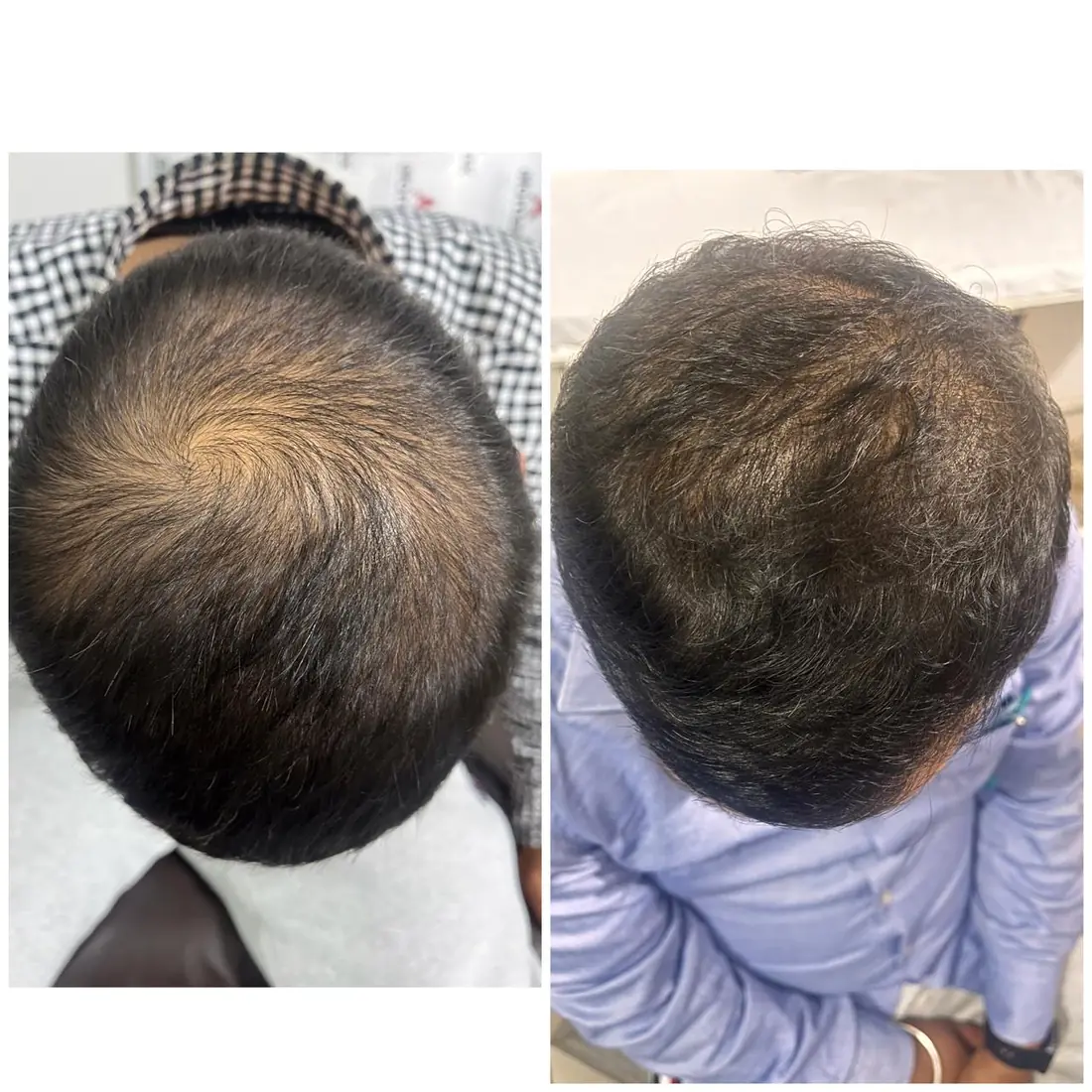 Hair fall treatment before and after showing crown regrowth, Motihari