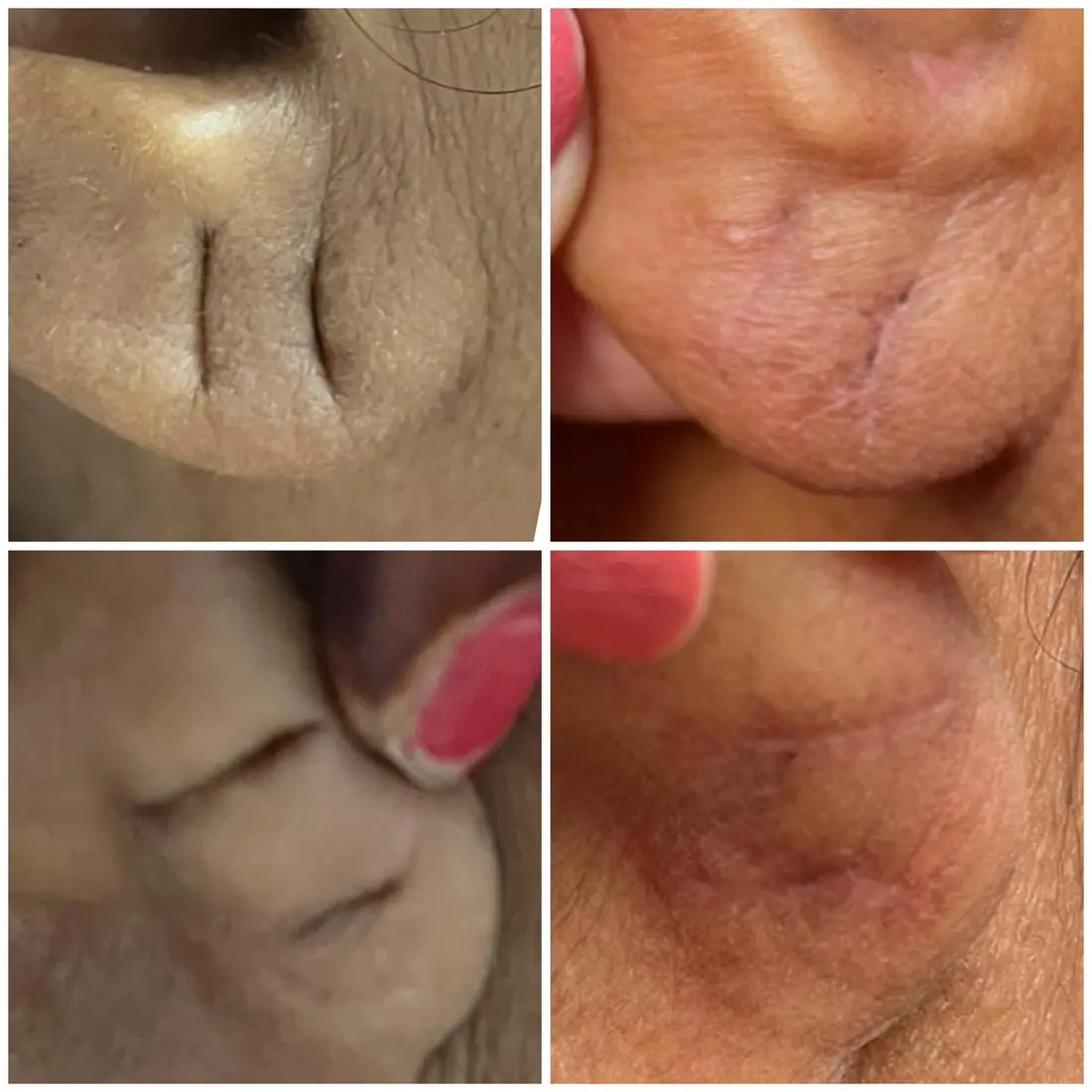 Earlobe repair before and after, split earlobe closed neatly, Motihari